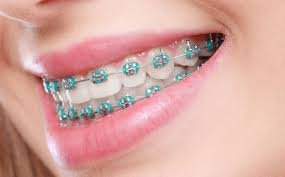 braces